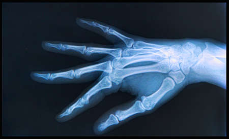 X-ray of human  Hand and fingers