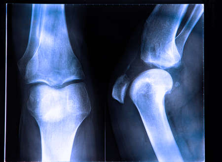Anterior cruciate ligament tear seen on x-rayの写真素材