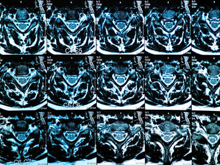 MRI of the cervical spineの写真素材