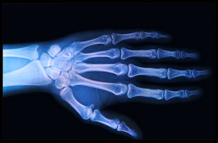 X-ray of human  Hand and fingersの写真素材