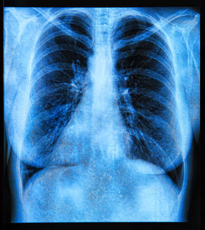X-Ray image if the human chestの写真素材