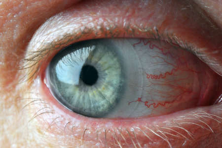Man eye with contact lenses and blood capillaries. Macro shot.