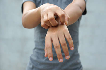 Woman scratching arm from itching on light gray background. Cause of itchy skin include insect bites, dermatitis, food/drugs allergies or dry skin. Concept of health care skin.の写真素材