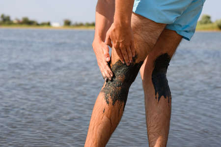 A man smears therapeutic mud on the back of the thigh and tendons. Treating psoriasis and other skin...