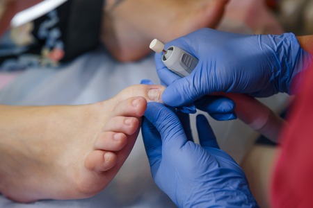 Podology treatment. Podiatrist treating toenail fungus. Doctor removes calluses, corns and treats...