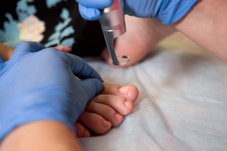Podiatrist treating toenail fungus. Podology treatment.の写真素材