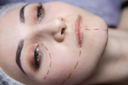 Preparation for plastic surgery. Young model in the clinic with perforation lines on her face.