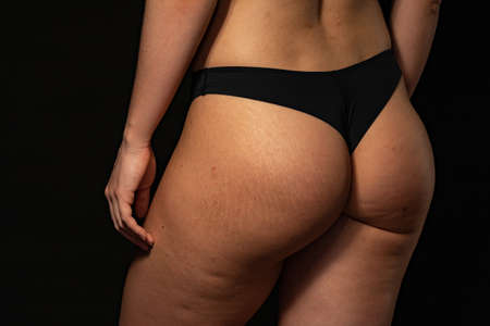 problem of cellulitis. sports ass on a black backgroundの写真素材