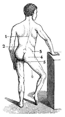 Transient synovitis of hip (also called toxic synovitis). Illustration of the 19th century. Germany. White background.の写真素材