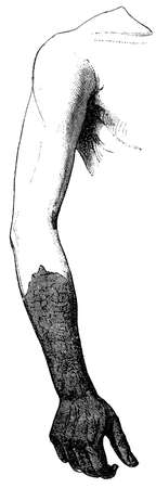 Gangrene of the hand. Illustration of the 19th century. Germany. White background.の写真素材