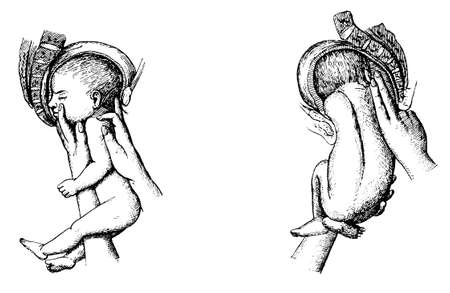 Obstetrics. Childbirth. Illustration of the 19th century. Germany. White background.の写真素材