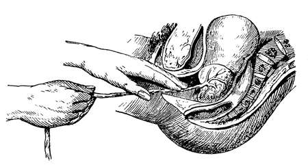 Obstetrics. Childbirth. Artificial removal of the placenta. Illustration of the 19th century. Germany. White background.の写真素材