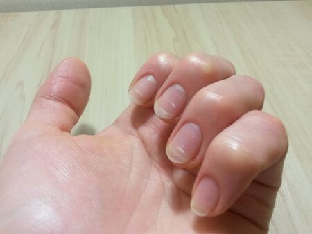 Spring avitaminosis of nailsの写真素材