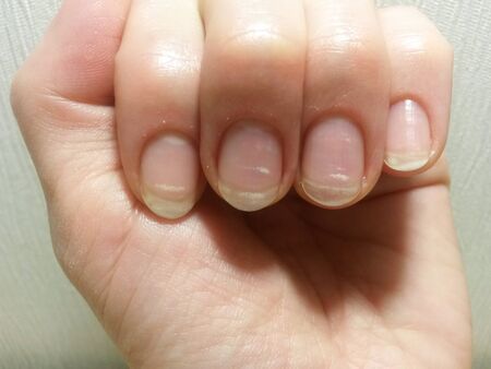 Spring avitaminosis of nailsの写真素材