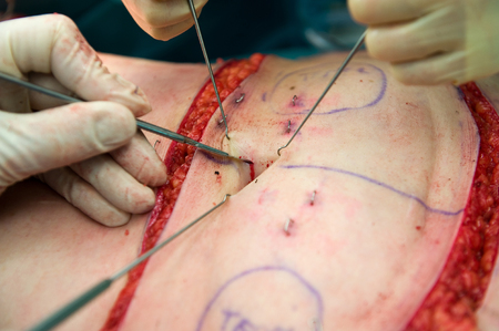 A surgeon making an incision near the belly button during an operationの写真素材