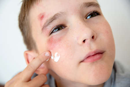 Close-up of the boy's face with a sadina. The child treats the wound on the faceの写真素材