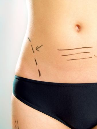 Closeup photo of an attractive Caucasian woman's abdomen and leg marked with lines for abdominal cellulite correction cosmetic surgery.の写真素材