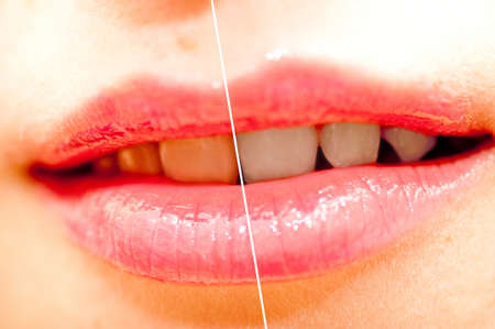 woman teeth before and after whitening.の写真素材