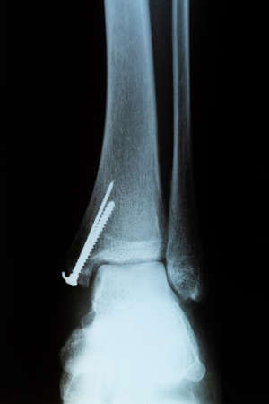 Front view of X-RAY scan. Human leg with metal screw after the surgery.