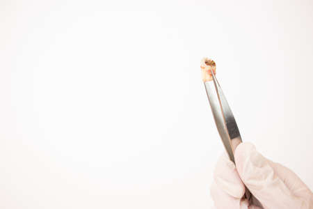 Decayed Tooth.