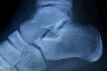 x-ray ankleの写真素材