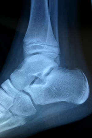 x-ray ankleの写真素材