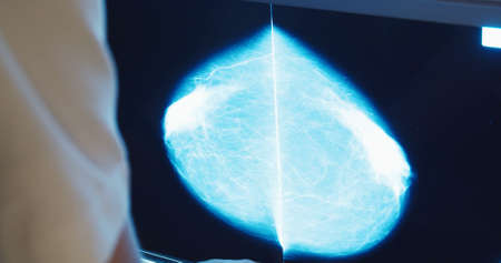 Breast cancer prevention. Doctor checking the mammogram snapshot of breast on the monitors.の写真素材