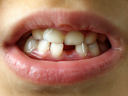 Missing tooth smile kid or children mouth closeup or macro