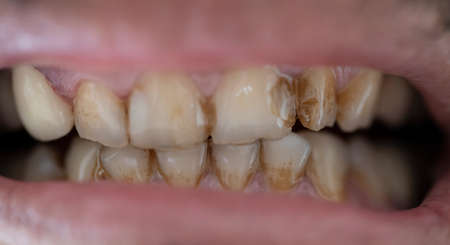 Decayed teeth close-up. There are brown spots on the tooth. Some of the teeth are visible.の写真素材