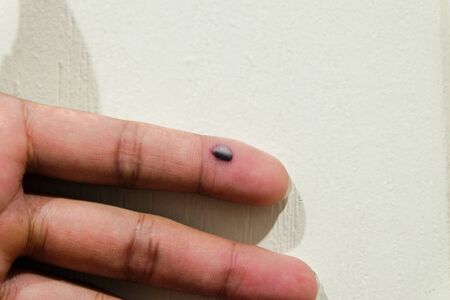 bruise in fingerの写真素材
