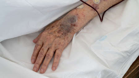 Ankara, Turkey - March 2021: Arm of an old person with bruises receiving blood transfusion serum in hospital roomのeditorial素材