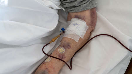 Ankara, Turkey - March 2021: Old person receiving blood transfusion serum in hospital roomのeditorial素材