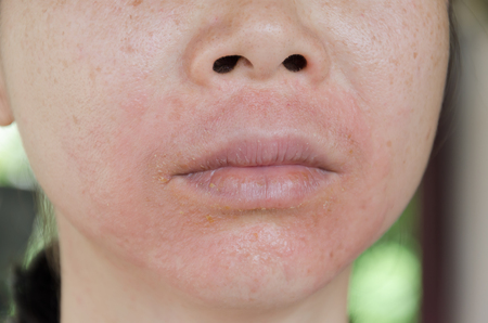 Human skin, presenting an allergic reaction, allergic rash.の写真素材