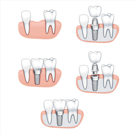 Tooth Implant Illustration, Healthy Teeth, Dentist Vector Illustration, Oral Care. Dental Implant Illustrationのイラスト素材