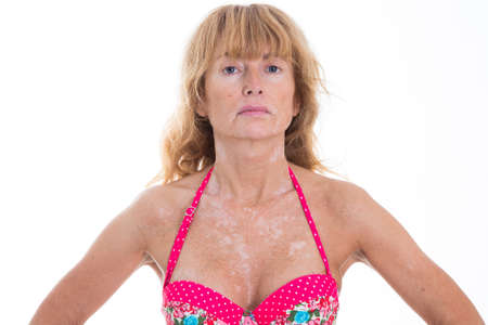 portrait of adult woman with vitiligo marksの写真素材