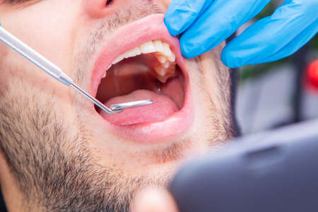 dentist with tools working on the patient's mouthの写真素材
