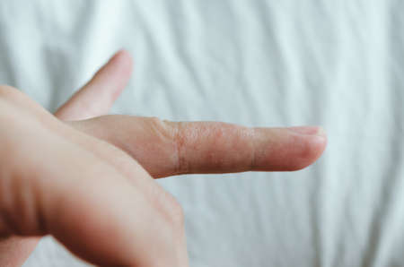 Close-up of the ring finger drying up from dyshidrosis.