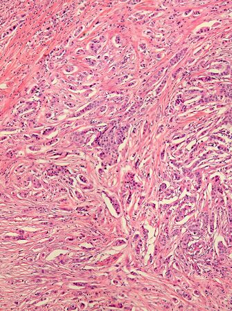 Real photomicrograph of breast adenocarcinoma. Panorama of a slide under the microscope. Some areas will be blurry due to the nature of the tissue.の写真素材