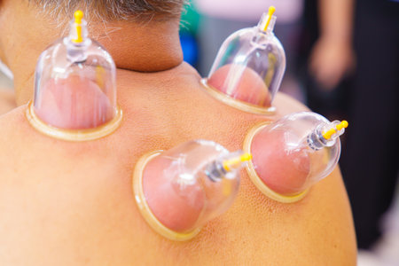 Close up for multiple vacuum cups, medical cupping therapy on human body. Doctor with cups for patient, therapy. Wellness, health injury rehabilitation concept. Alternative medicine.の写真素材
