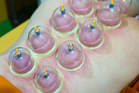 Close up for multiple vacuum cups, medical cupping therapy on human body. Doctor with cups for patient, therapy. Wellness, health injury rehabilitation concept. Alternative medicine.の写真素材