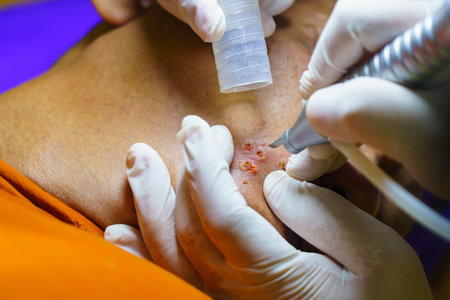 close up cosmetology procedure laser freckle skin removal on body parts. laser procedure. Cosmetic treatment in beauty clinic, resurfacing technique for wrinkles, scars and solar damage on skin.の写真素材