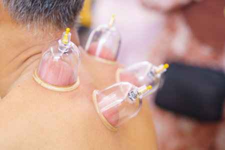 Close up for multiple vacuum cups, medical cupping therapy on human body. Doctor with cups for patient, therapy. Wellness, health injury rehabilitation concept. Alternative medicine.の写真素材