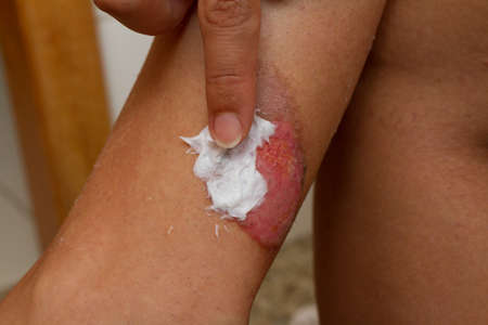 A woman applying ointment to a second degree muffler burn from a motorcycle