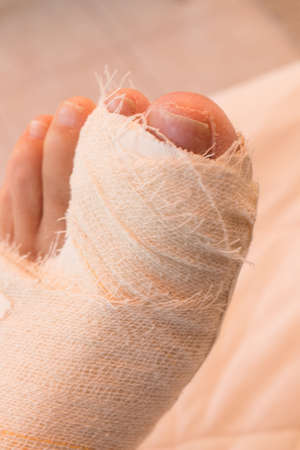 Close up of a Persons Bandaged up Broken Big Toeの写真素材
