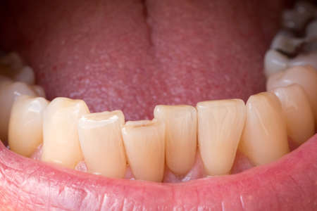 Man Showing his Bottom Teeth to the Dentistの写真素材