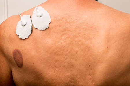 Patient that had cupping therapy done on his upper back and using a TENS Unit for pain relief