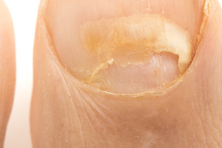 Toe nail fungus that has affected the big toe of a man.の写真素材