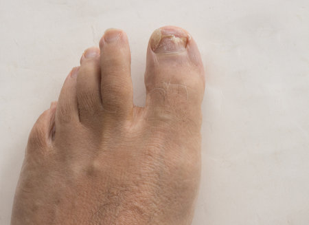 Toe nail fungus on a big toe causing the nail to fall offの写真素材