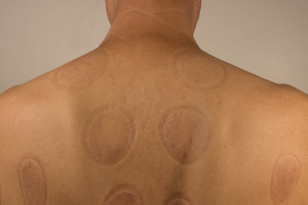 <p><strong>Mature man that had Cupping Therapy done on his back for pain relief</strong></p>
