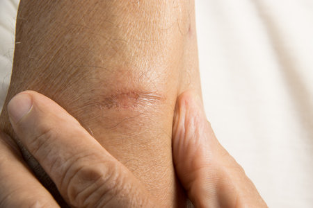 Man with a small minor first degree burn on his forearm